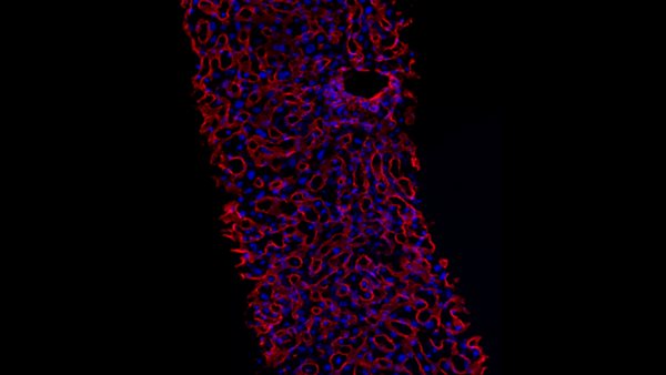 New hope for treating alcohol-related liver disease